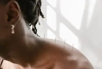 Acupuncture